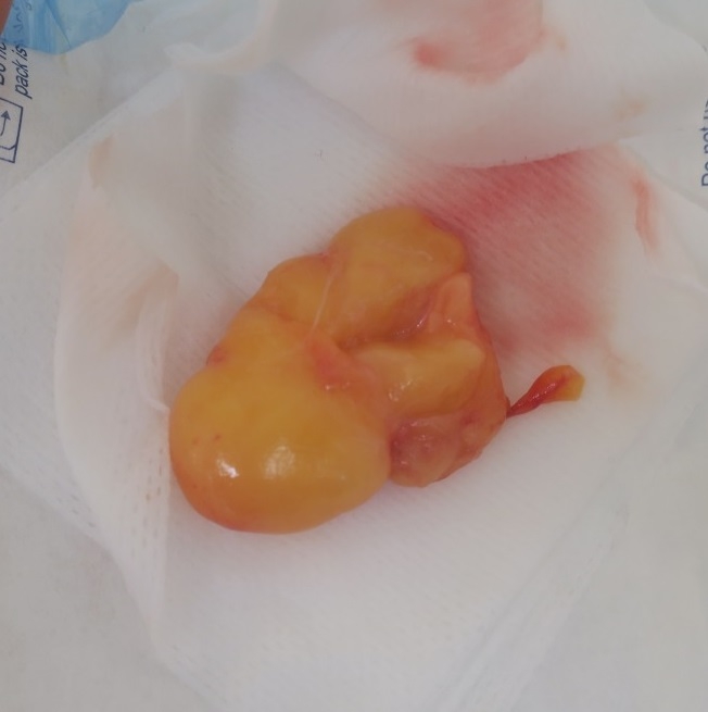 鼻の下のホクロ。切除後5か月目の経過。皮膚の凹凸も目立たなくなってきました。今日は脂肪腫の手術もありました(閲覧注意)