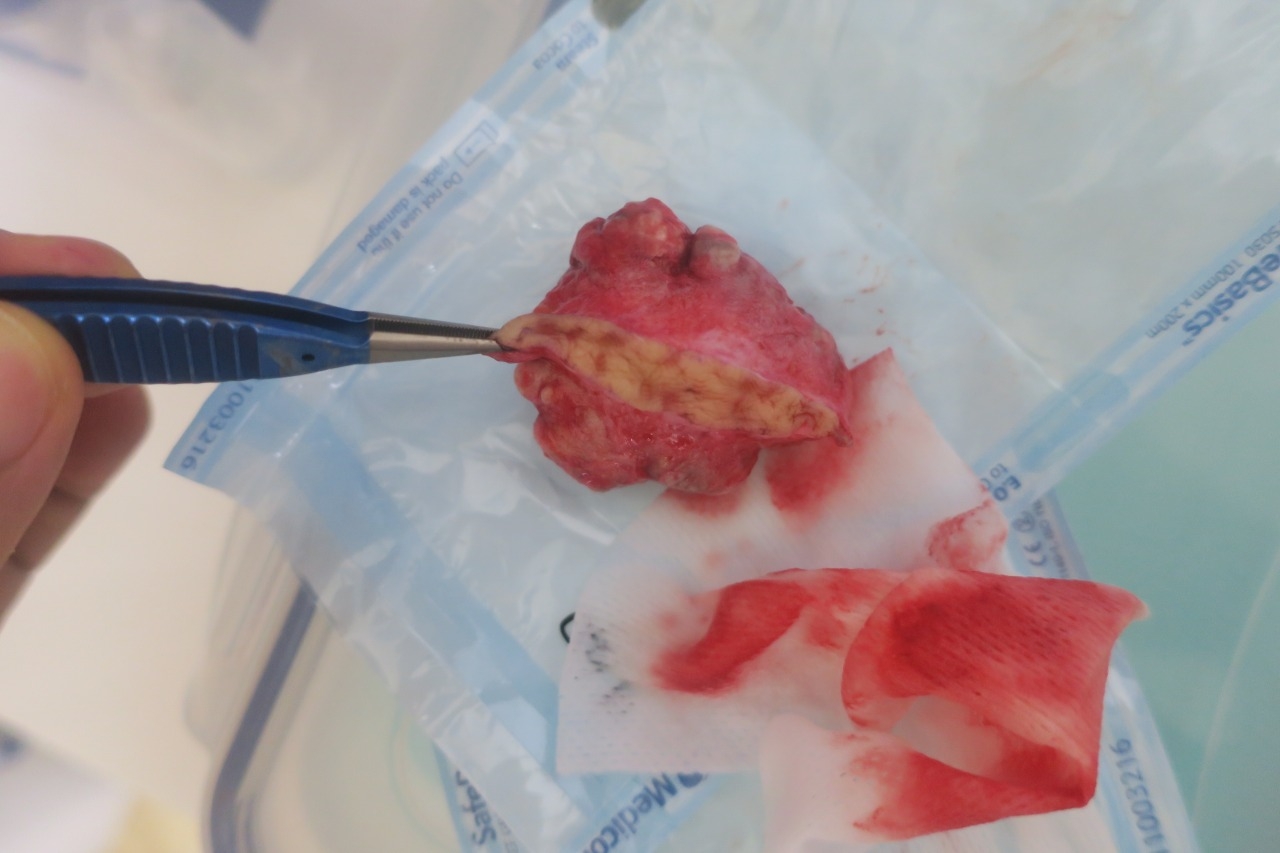 閲覧注意。今日は大きい脂肪腫に大きい粉瘤の切除をしました。こんなものが背中にあったら邪魔ですよね・・・