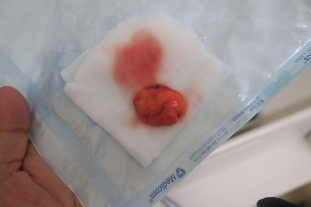 豊洲で薄毛AGA治療。2年9か月目。順調に復活してきていますがまだまだいけると思います。