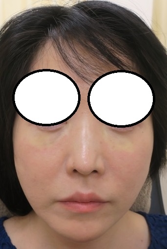 他院で目の下に入れたヒアルロン酸がボコボコニなってしまったのでハイラックスで溶解しました。直前・直後。