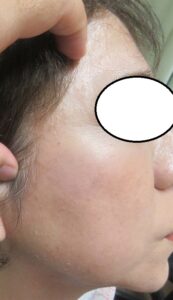 50代後半女性。右頬の巨大のシミをレーザーとゼオスキンで完璧に消しました。4ヶ月目の経過。