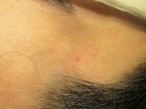 40代男性。こめかみの老人性血管腫(赤イボ)のレーザー治療。1ヶ月目の経過。
