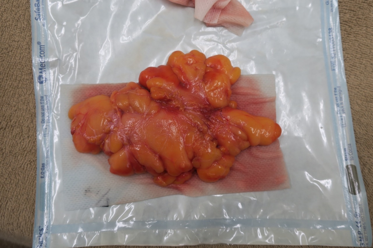 巨大な脂肪腫を切除しました~閲覧注意!!気持ち悪いのが無理な人は絶対見ないでくださいね。