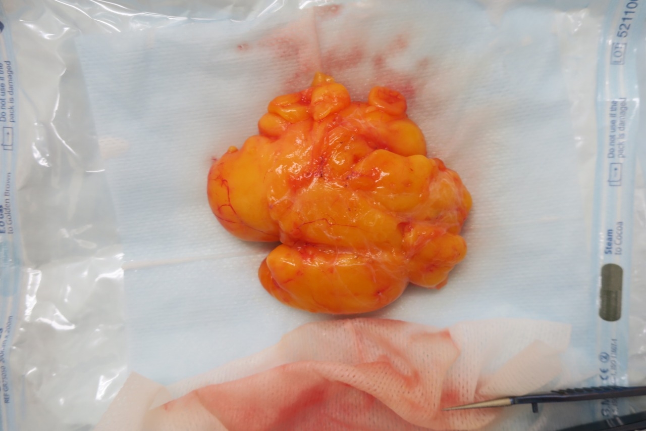 前腕のホクロ、切除後2か月目。今日も巨大な脂肪腫を切除しました(閲覧注意)。