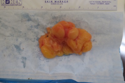 二の腕の脂肪腫を切除しました。昔からあったものが放置しておいて8センチほどに・・・閲覧注意。