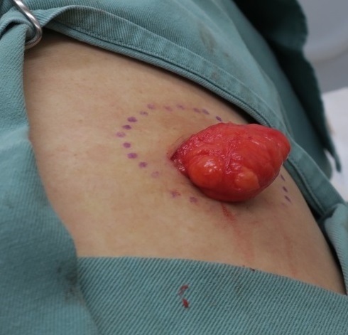 背中の脂肪腫。1か月後の傷。閲覧注意。