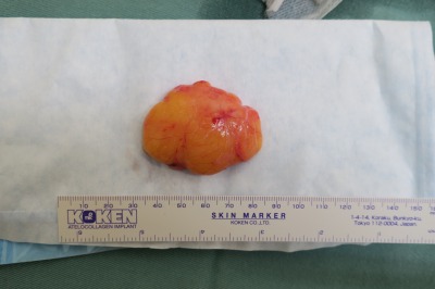 背中の大きな脂肪腫を切除しました。閲覧注意。徐々に大きくなってきている場合は早めの切除をお勧めします。