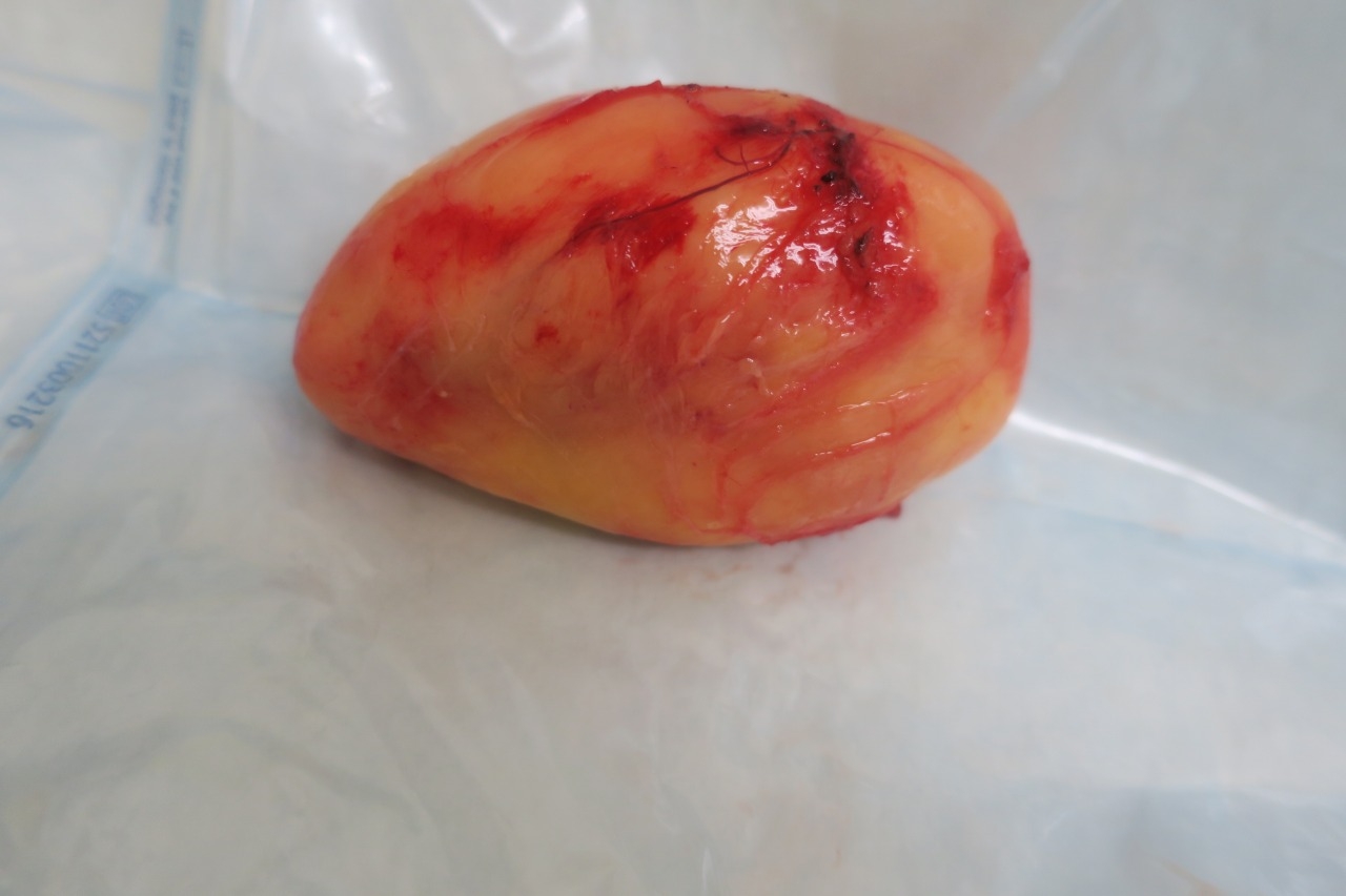 10センチ以上もある上腕の脂肪腫を摘出しました~閲覧注意ですよ~~~